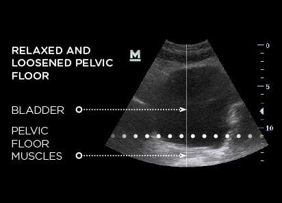 Ultrasound of a relaxed and loosened pelvic floor before BTL Emsella