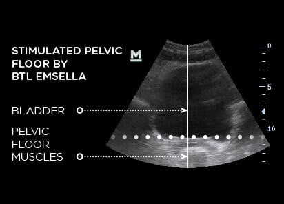 Ultrasound of a pelvic floor stimulated by BTL Emsella