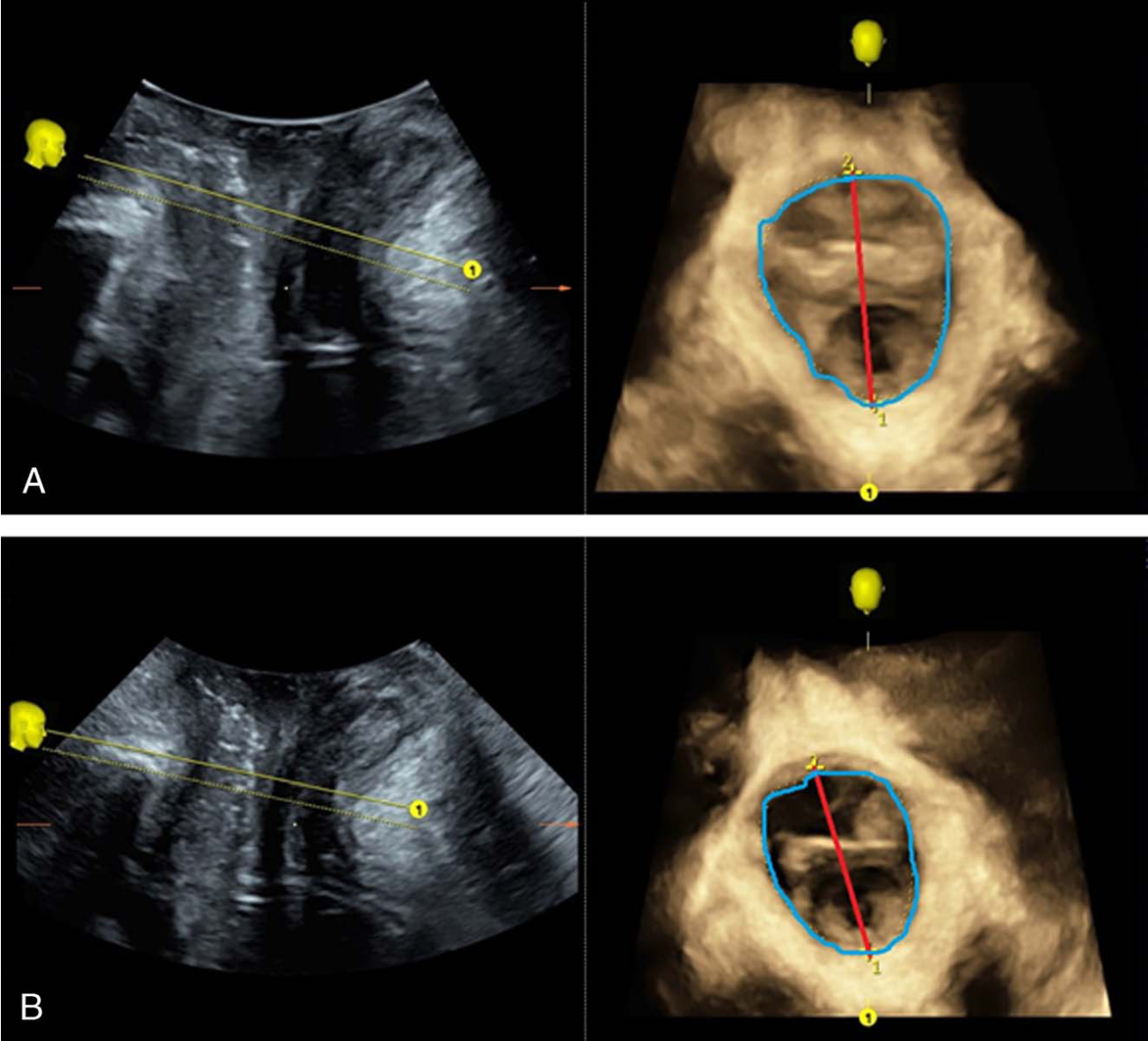 FIGURE 1. A 39-year-old patient, 1 childbirth. Visualization of ultrasound measurements (Voluson E10, equipped with RIC6-12-D transducer) before (A)…