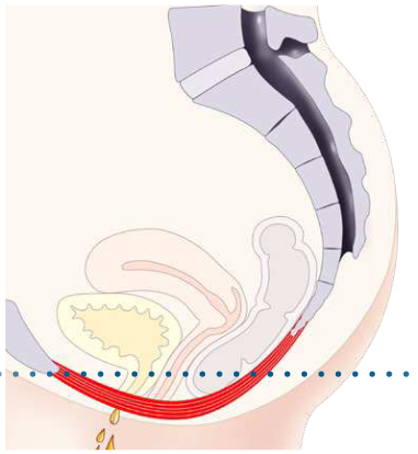 Figure 1: HIFEM technology mechanism of action
