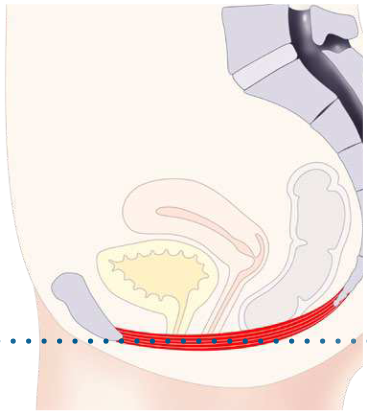 Figure 1: HIFEM technology mechanism of action (image 3)