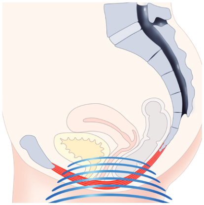 Figure 1: HIFEM™ technology (image 2)