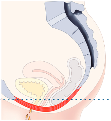 Figure 1: HIFEM™ technology