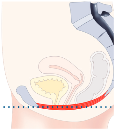 Figure 1: HIFEM™ technology (image 3)
