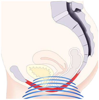 Figure 1: HIFEM technology mechanism of action (image 2)