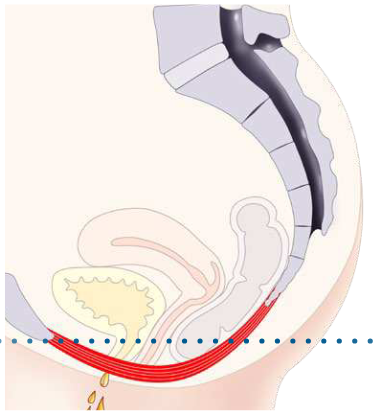 Figure 1: HIFEM technology mechanism of action