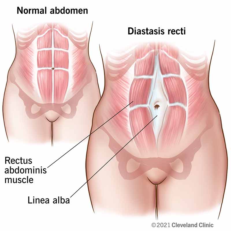 Diagram comparing a normal abdomen with diastasis recti separation of the abdominal muscles