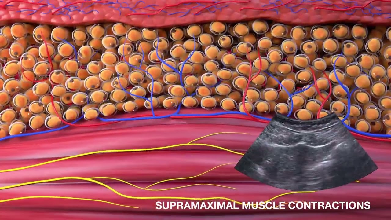 BTL Emsculpt - Supramaximal Muscle Contractions
