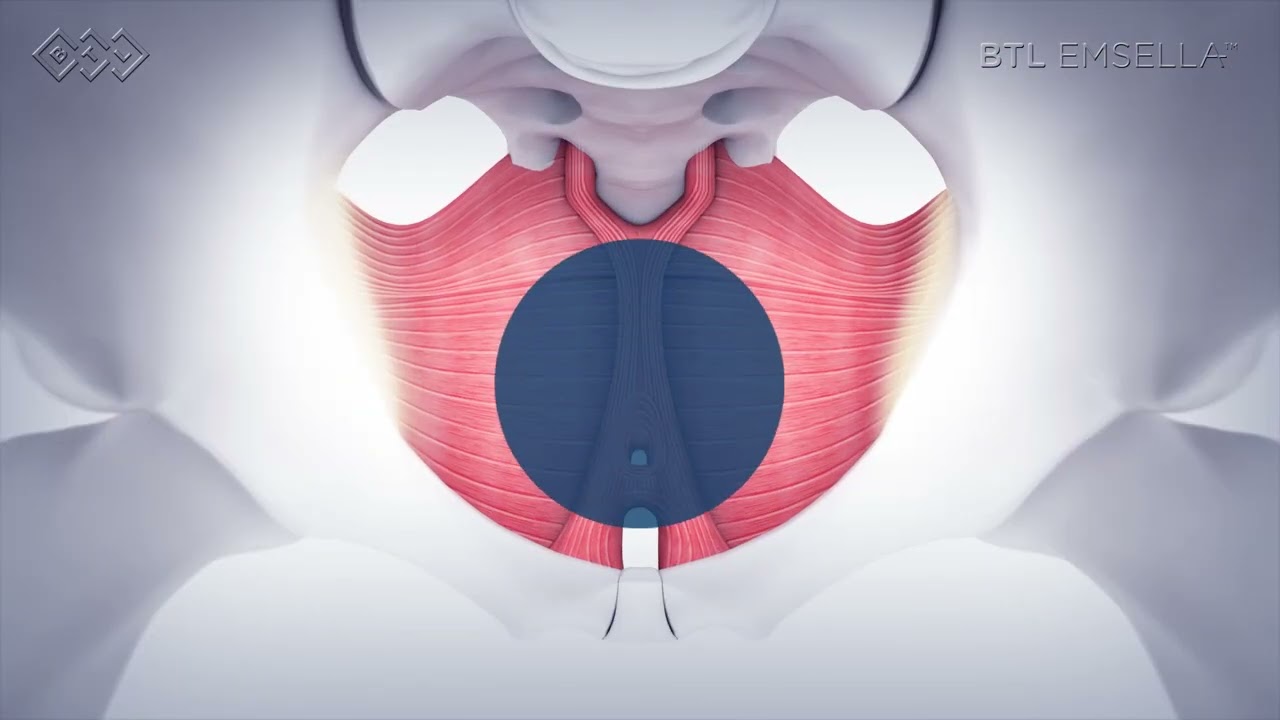 BTL Emsella - How It Works on the Inside