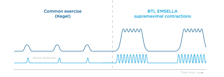 Graph chowing the difference in intensity of supramaximal contractions versus Kegel contractions