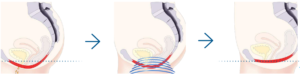 Three illustrations of female pelvic floor before, during and after HIFEM treatment - Corelife wellness