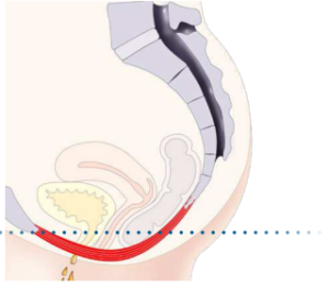 Illustrations of female pelvic floor with weak muscles  - Corelife wellness