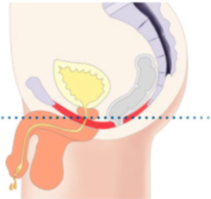 Illustrations of male pelvic floor with weak muscles - Corelife wellness