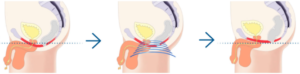 Three illustrations of male pelvic floor before, during and after HIFEM treatment - Corelife wellness