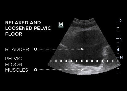 Emsella Therapy For Men  Non-Invasive Treatment for UI & ED